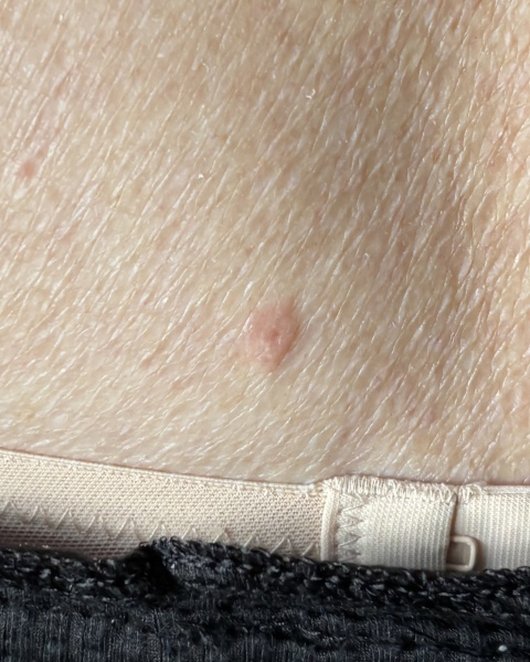 What is this on my back?