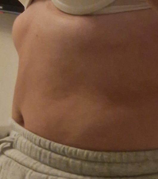 Lump??