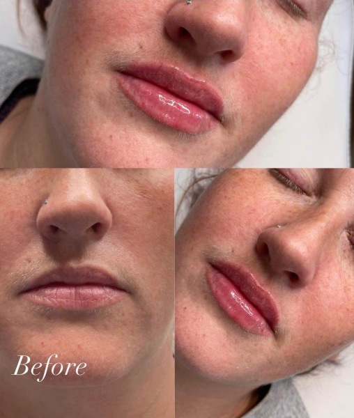 To think that botox, fillers, and other facial procedures are becoming too common?