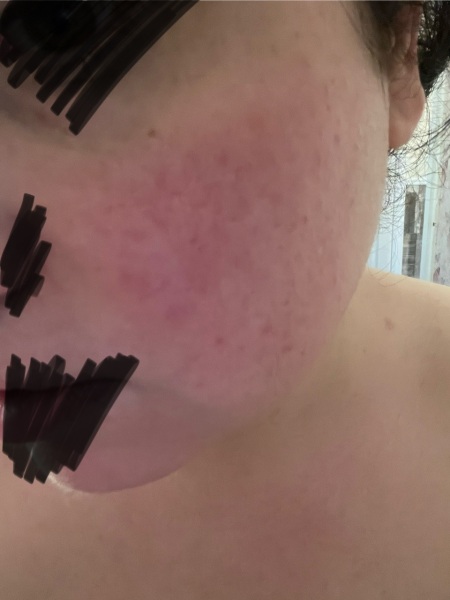 Is this rosacea? It's driving me mad