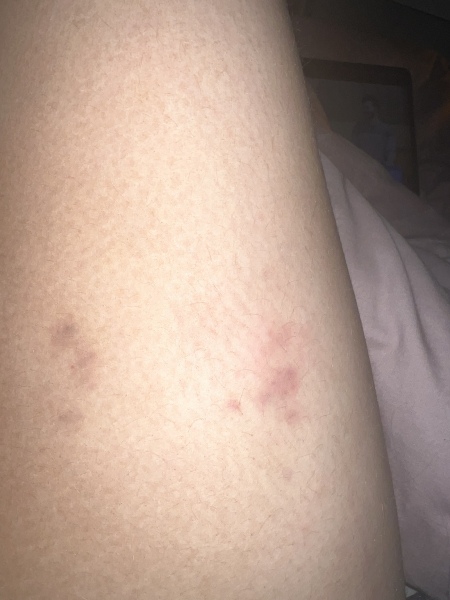 Advice on itchy skin and bruising
