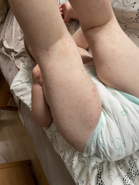 2 year old's rash/spots after eating soy