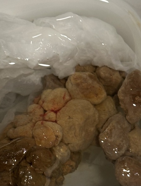Blood in sons poo? *photo*