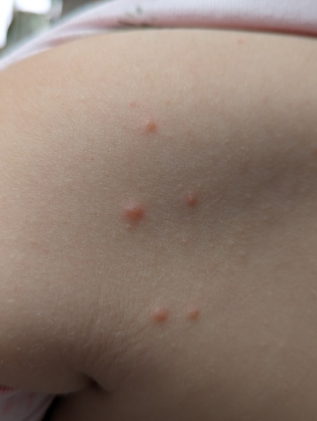 Chickenpox?