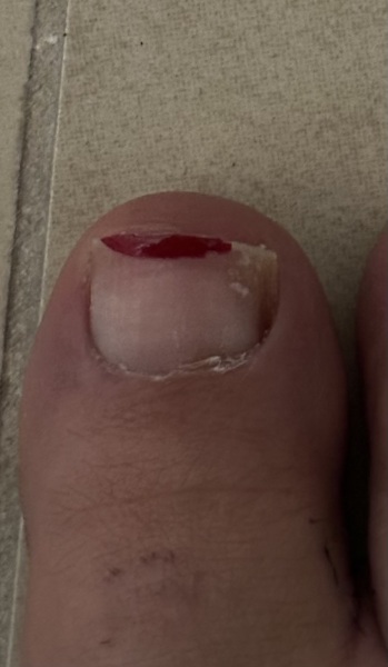 Photo warning Fungal toenail or subungual melanoma? HeLp!!