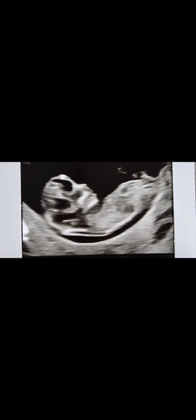 Guess the baby scan gender with me