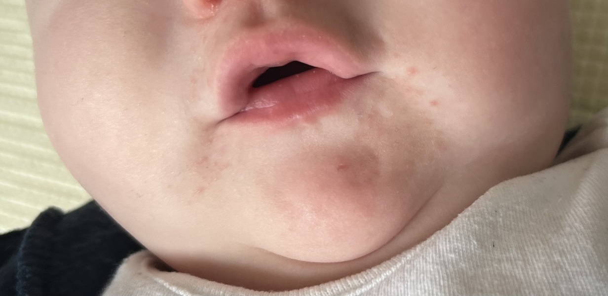 Is this dribble rash?