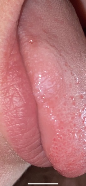 Cluster of white spots on side of tongue