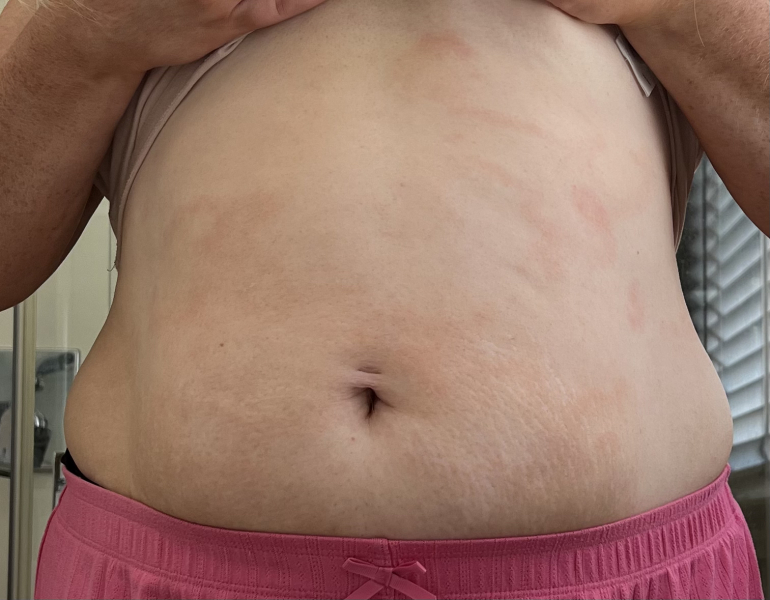 What is this rash on my stomach? Photos attached
