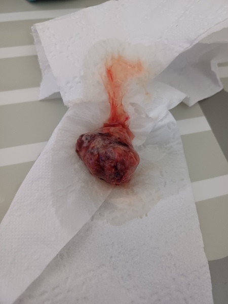 Passed something huge 10 weeks after D and C