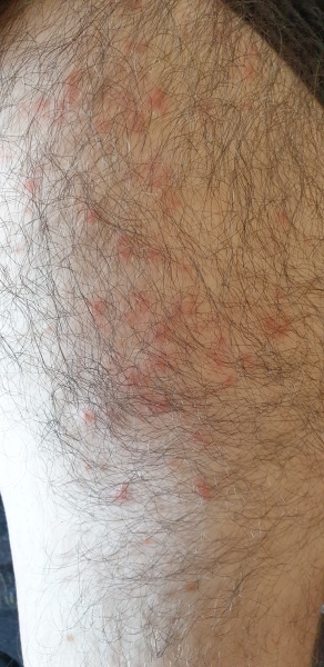 Is this psoriasis?