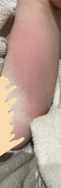 2 year old - rash on legs