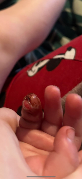 Healing of finger wound