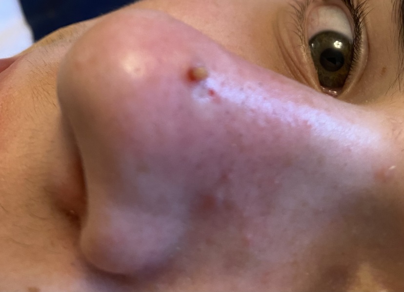 Sunday treat- blackhead