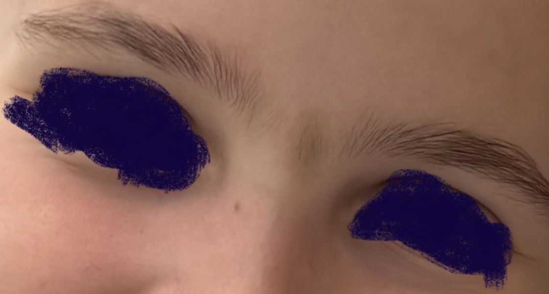 Birth mark on face getting bigger