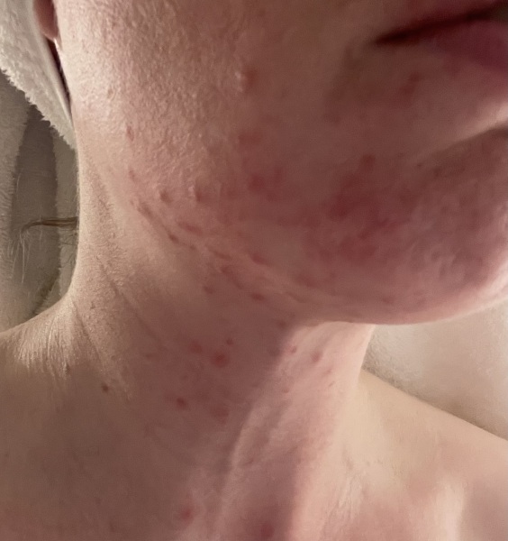 Please help me. I’m on holiday and my skin has massively broken out - how do I calm this down? Panicking