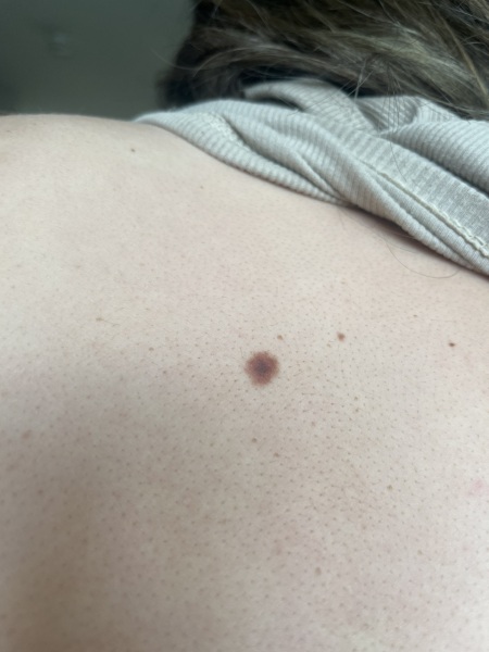 Slightly concerned about a mole?