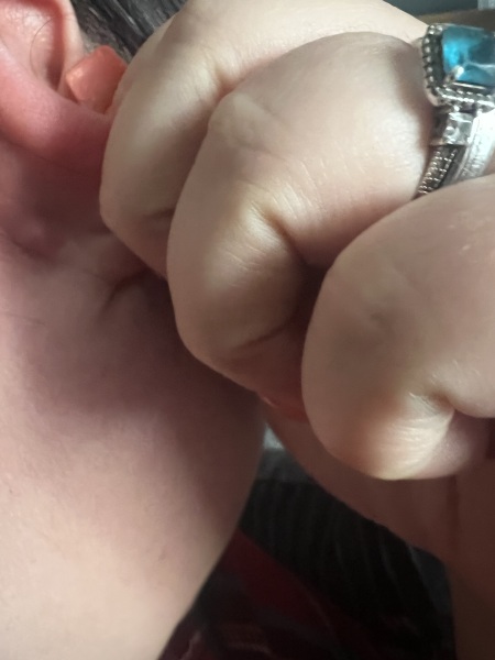Constant cysts!