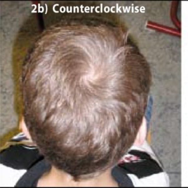 5 year old daughter suddenly got bald spot on her head!! Help