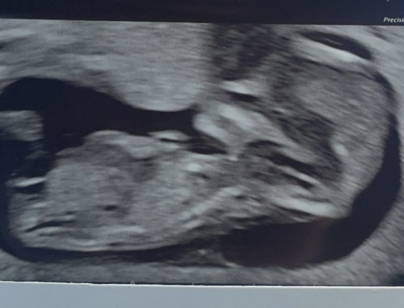Boy or girl? Mixed opinions, scan is tomorrow!