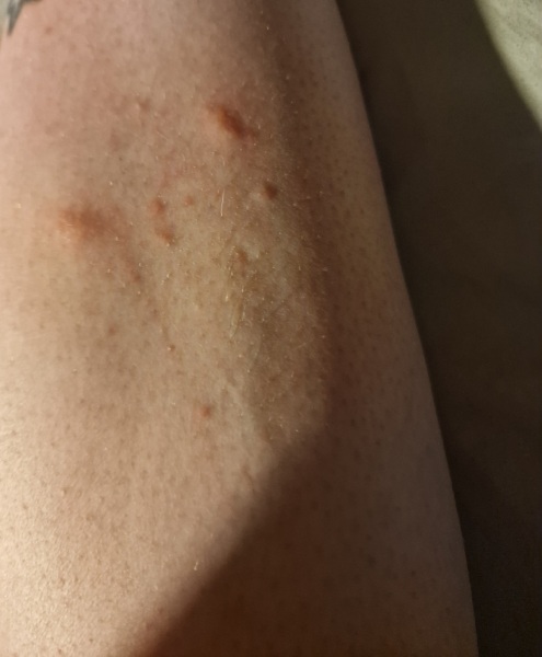 Reoccurring itchy lumps on legs....
