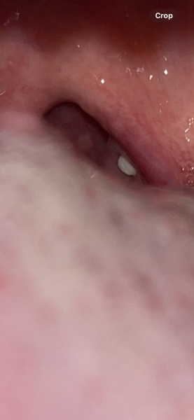 Tonsillitis? Photo of throat attatched