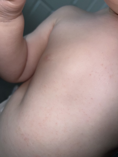 Anyone’s toddlers had a similar rash to this? Pic included
