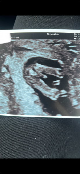 Nub or umbilical cord in potty shot?