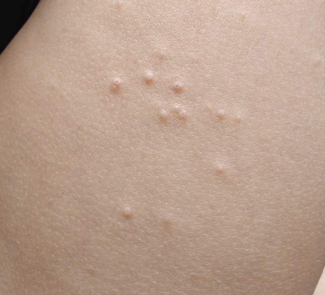 What kind of rash does this look like?