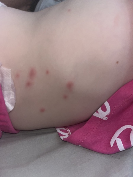Chicken pox or something else?