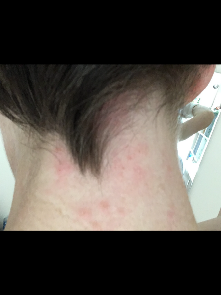 Does this look like shingles?