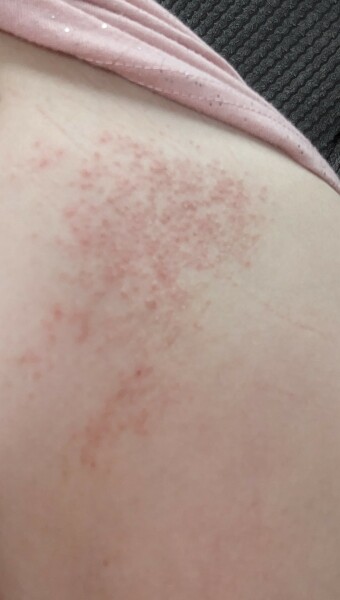 Shingles