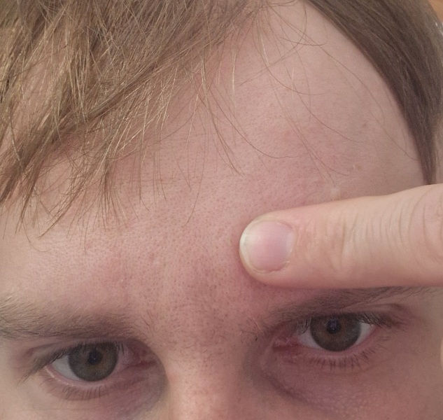 (Photo) Pain in the forehead in this place, what could it be?