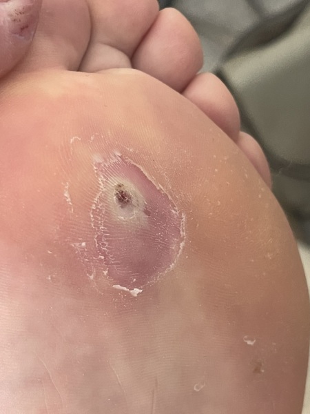 Have I killed my veruca? WARNING PIC ATTACHED