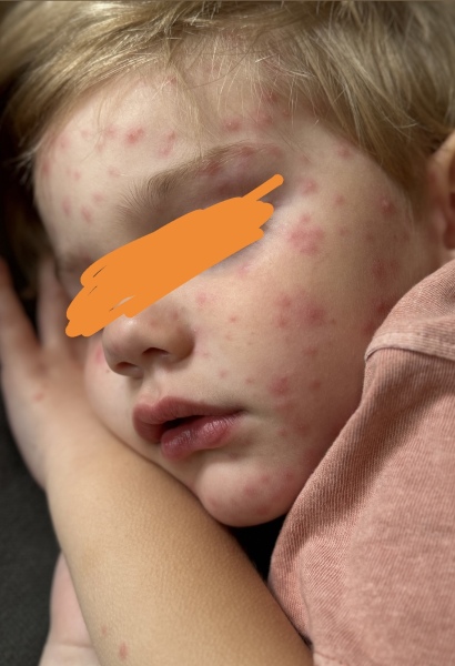 Chicken pox