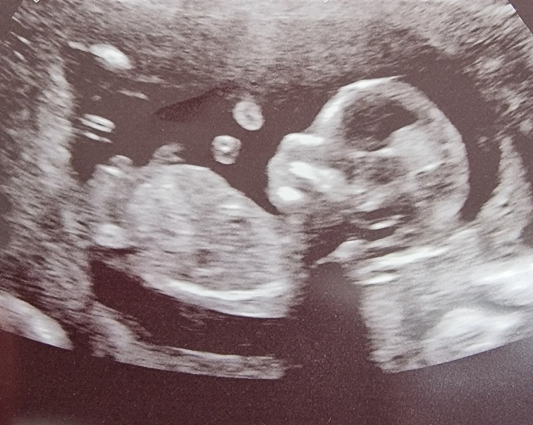 Just for fun, 12 week scan gender guesses?