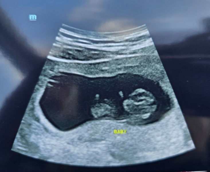 Can I see your 8-10 weeks scans