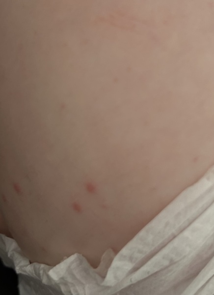Is this chickenpox?