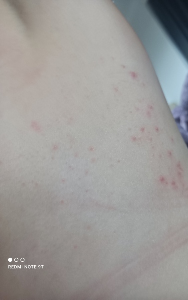 To ask what this rash is?