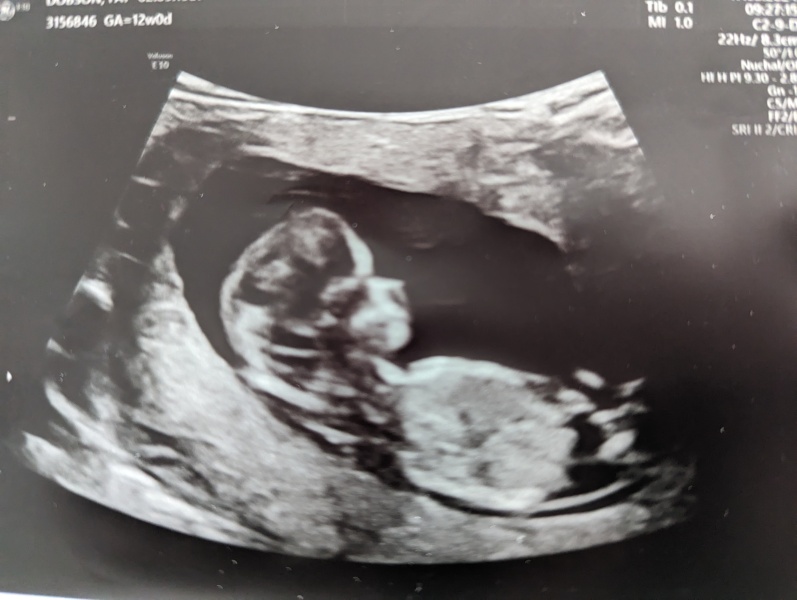 12 week scan - definitely a girl?