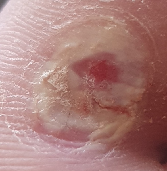 Is this a verruca still?? Picture attached