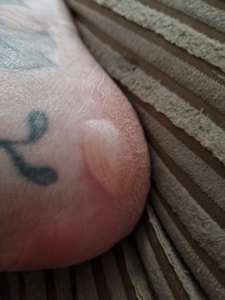 Water blister (with pic)