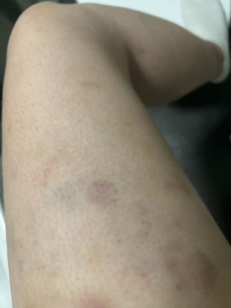 Advice on itchy skin and bruising