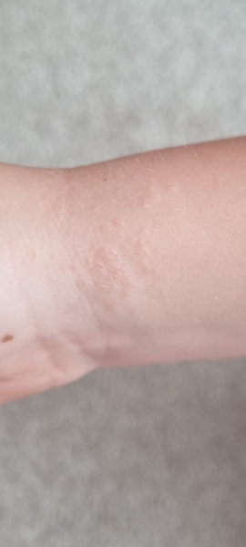 Does anyone know what this rash is