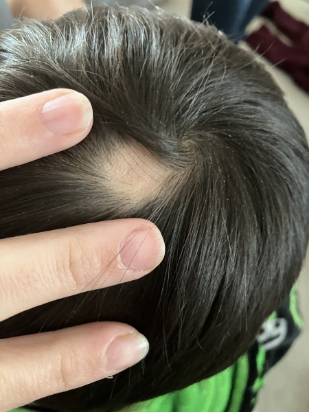Alopecia areata