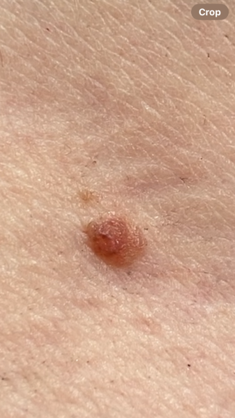 Mole with bump on top