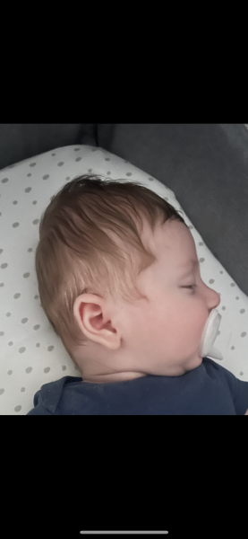 Severe plagiocephaly baby