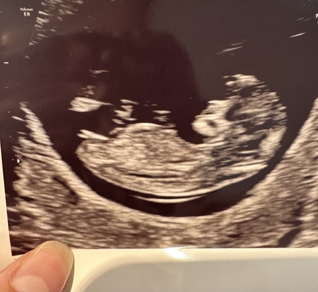 12 week scan