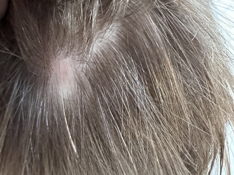 Toddler alopecia? Bald spot on head. Help please!