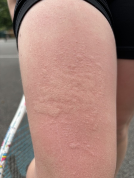 Hives